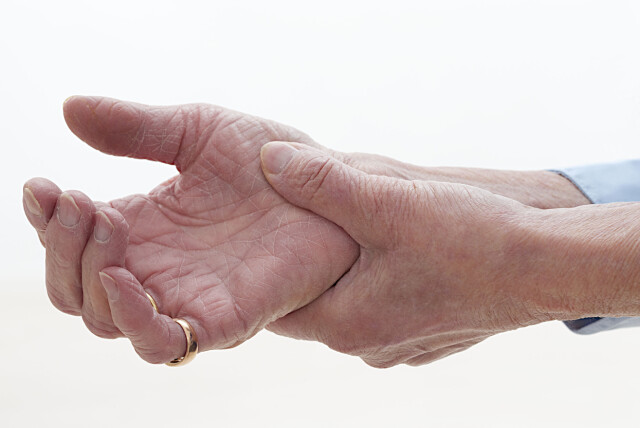 PSORIASISLEDDGIKT: I tillegg til hudplagene, har de til felles en betennelsesreaksjon i ledd som medfører smerte, stivhet og vanligvis leddhevelse. Foto: Foto: NTB Scanpix PSORIASISLEDDGIKT: I tillegg til hudplagene, har de til felles en betennelsesreaksjon i ledd som medfører smerte, stivhet og vanligvis leddhevelse. Foto: Foto: NTB Scanpix